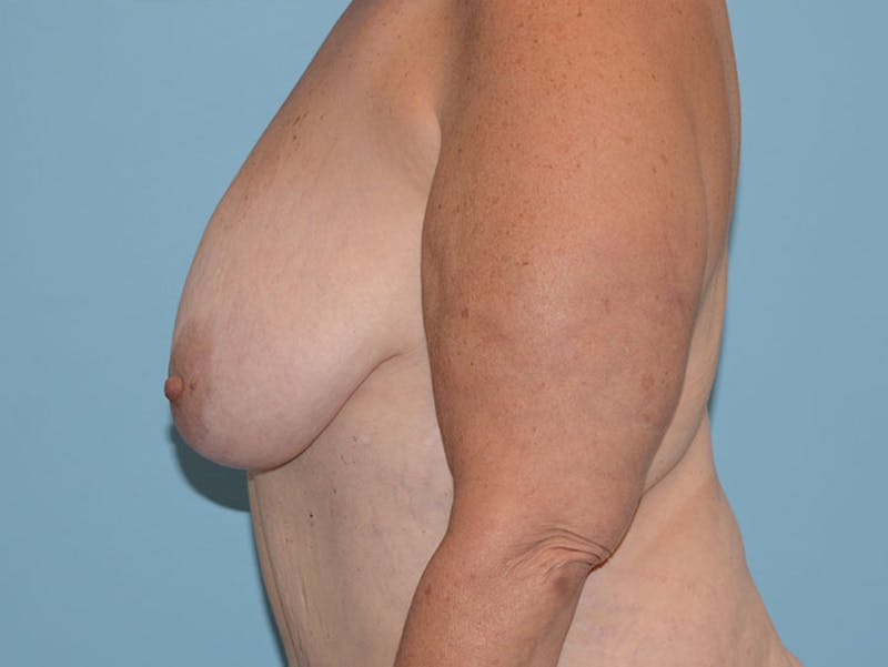 Breast Lift Before & After Gallery - Patient 120902784 - Image 3