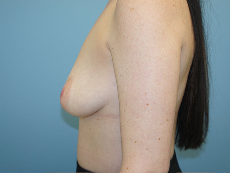 Breast Lift Before & After Gallery - Patient 120902797 - Image 5