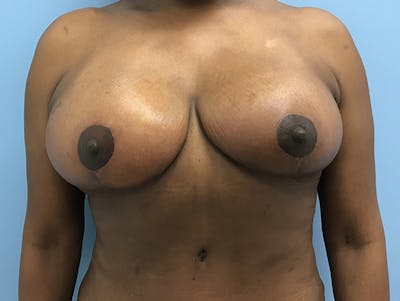 Breast Lift Before & After Gallery - Patient 120902800 - Image 2