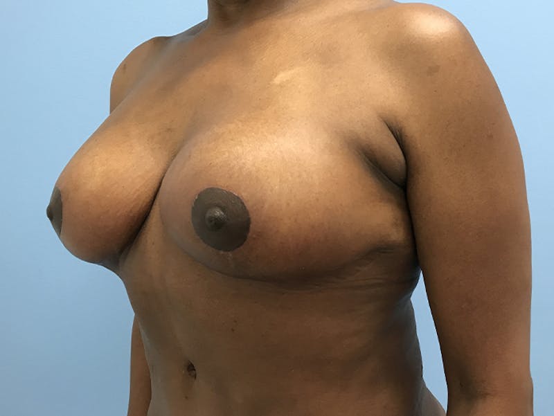 Breast Lift Before & After Gallery - Patient 120902800 - Image 4