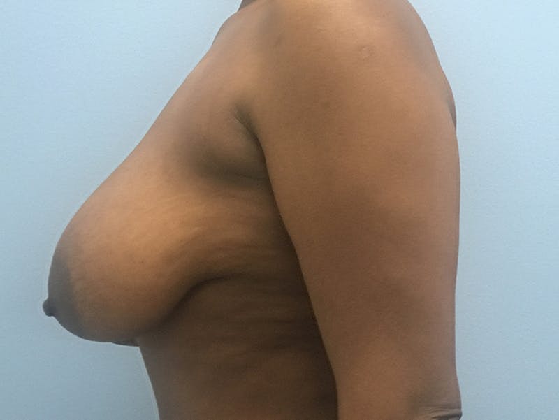 Breast Lift Before & After Gallery - Patient 120902800 - Image 5