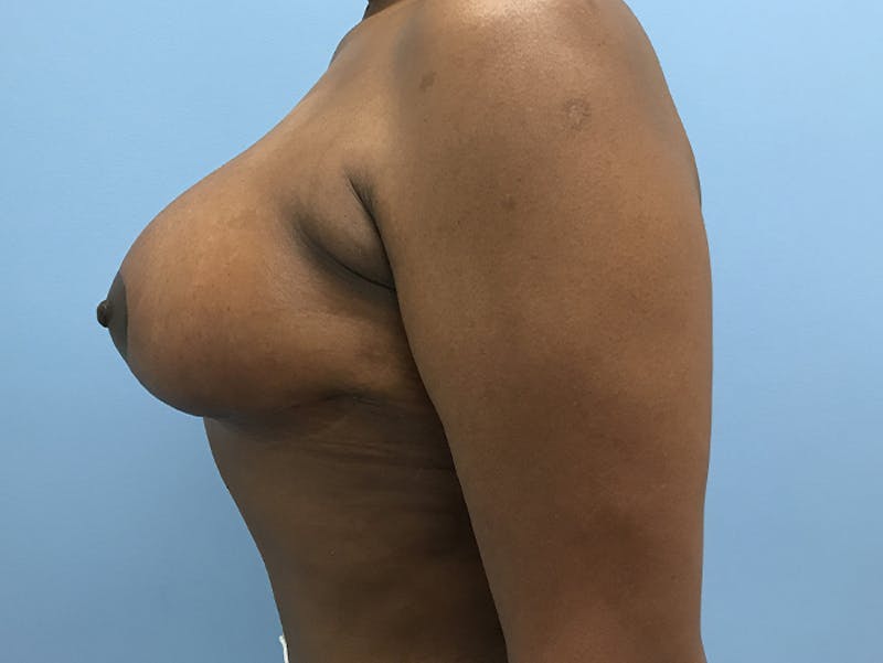 Breast Lift Before & After Gallery - Patient 120902800 - Image 6