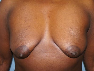 Breast Lift Before & After Gallery - Patient 120902801 - Image 1