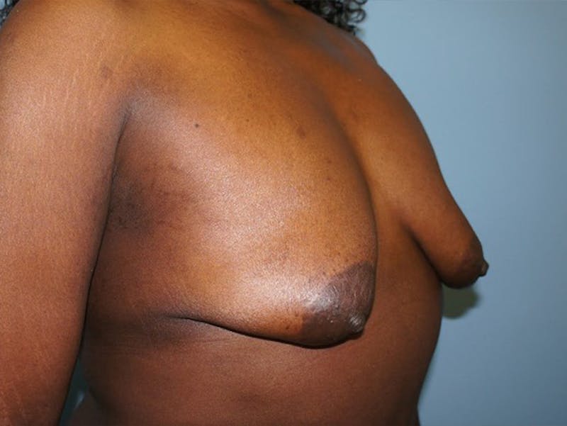 Breast Lift Before & After Gallery - Patient 120902801 - Image 3