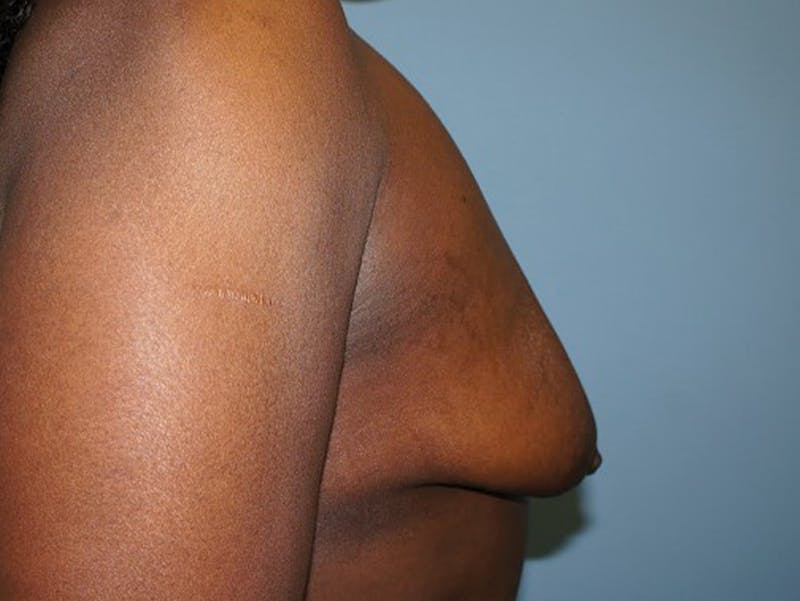 Breast Lift Before & After Gallery - Patient 120902801 - Image 5