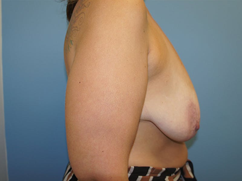 Breast Lift Gallery - Patient 120902808 - Image 5