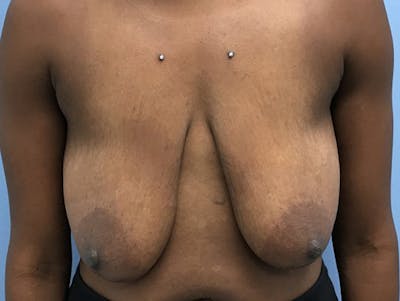 Breast Lift Gallery - Patient 120902811 - Image 1