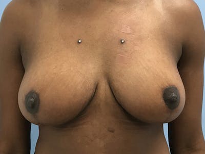 Breast Lift Before & After Gallery - Patient 120902811 - Image 2