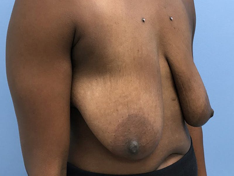 Breast Lift Before & After Gallery - Patient 120902811 - Image 3