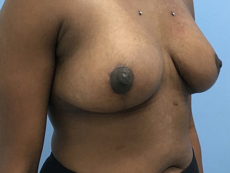 Breast Lift Before & After Gallery - Patient 120902811 - Image 4