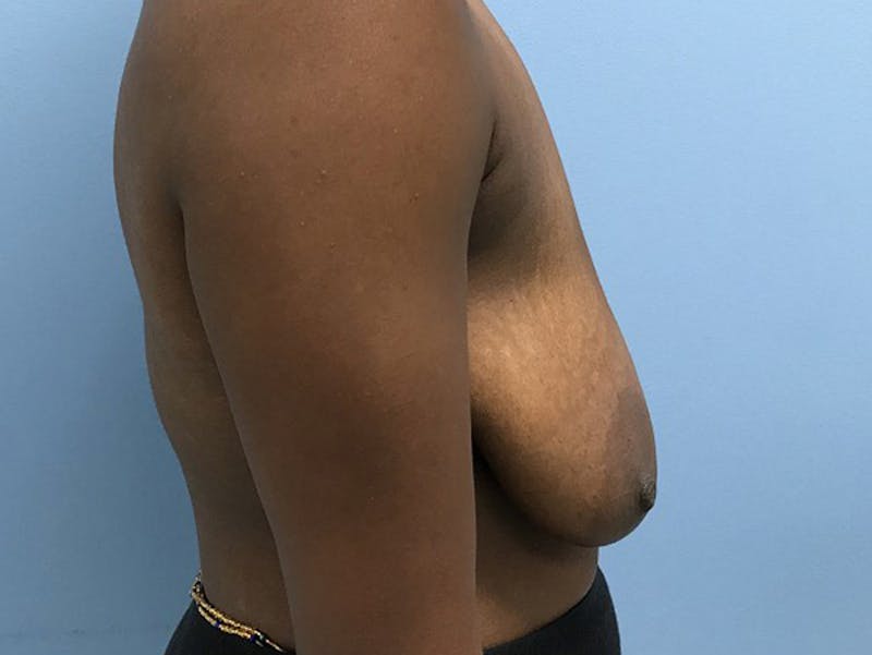 Breast Lift Before & After Gallery - Patient 120902811 - Image 5