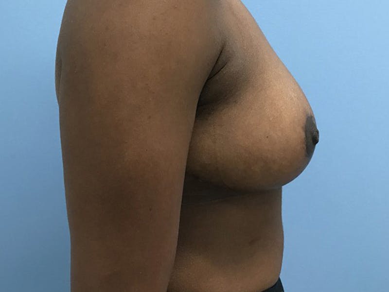 Breast Lift Before & After Gallery - Patient 120902811 - Image 6