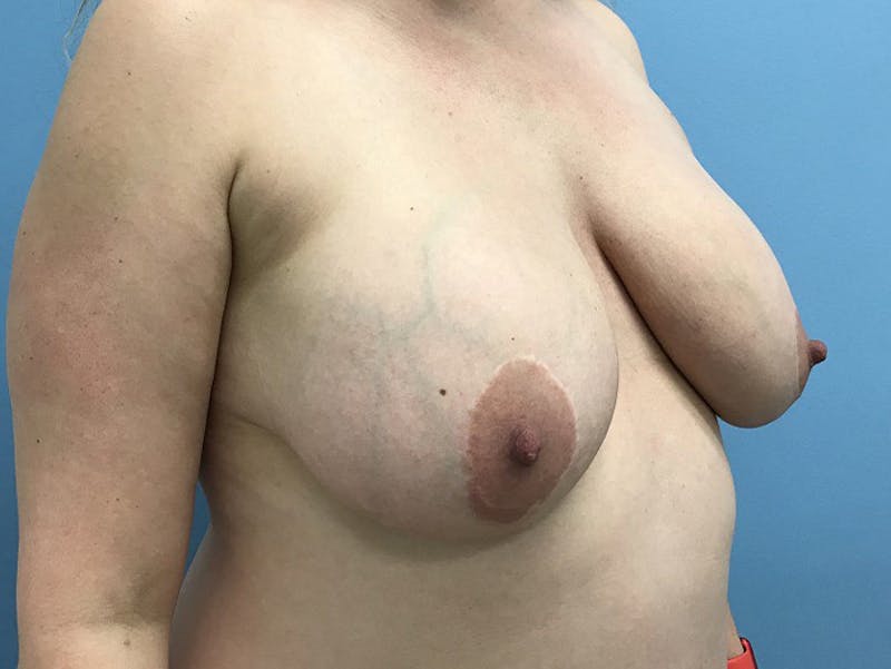 Breast Lift Before & After Gallery - Patient 120902812 - Image 3