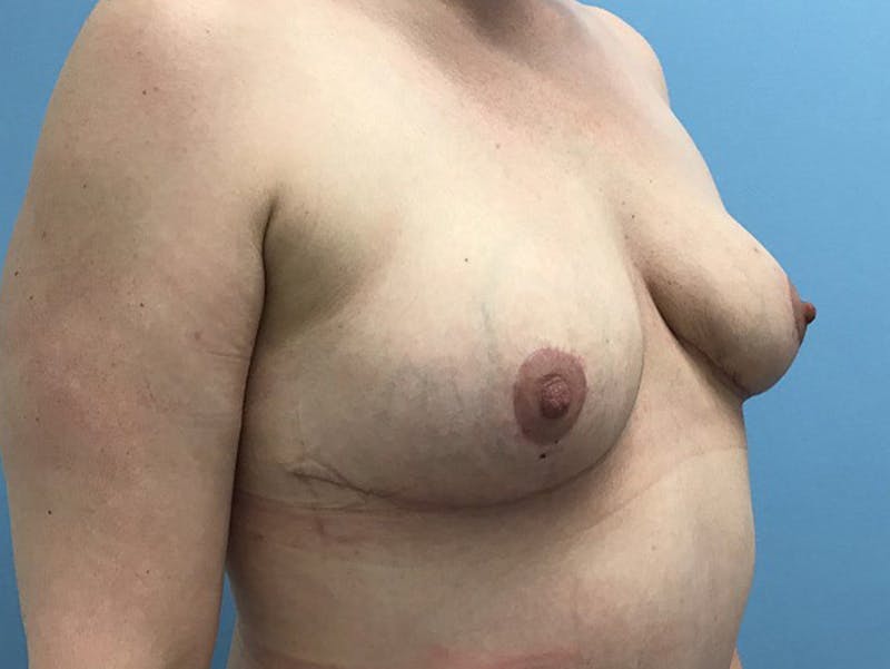 Breast Lift Gallery - Patient 120902812 - Image 4