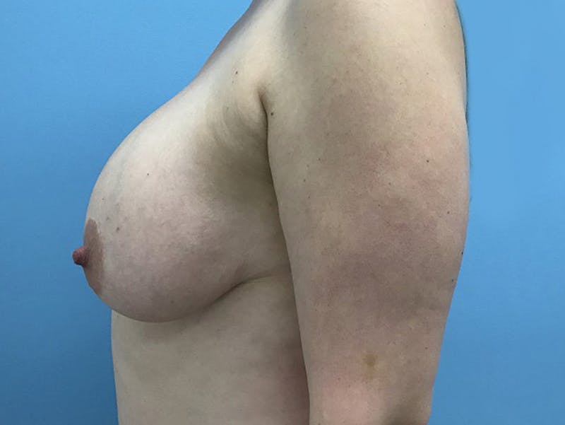 Breast Lift Before & After Gallery - Patient 120902812 - Image 5