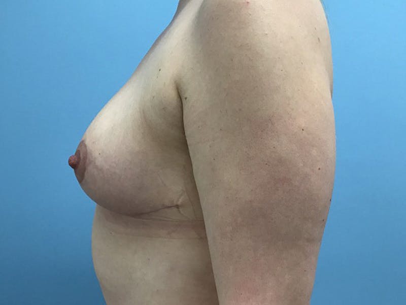Breast Lift Before & After Gallery - Patient 120902812 - Image 6