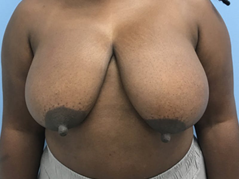 Breast Lift Before & After Gallery - Patient 120902813 - Image 1