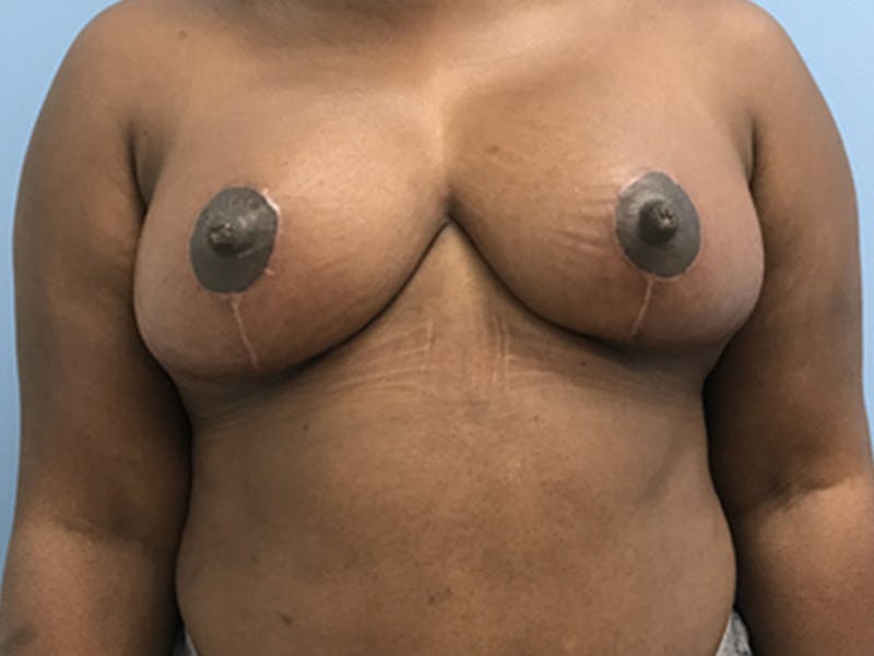 Breast Lift Before & After Gallery - Patient 120902813 - Image 2