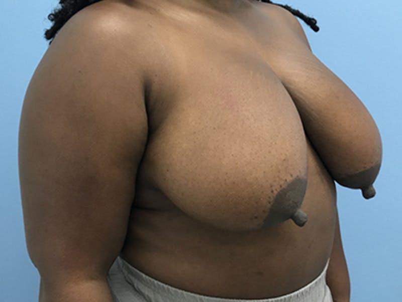 Breast Lift Before & After Gallery - Patient 120902813 - Image 3