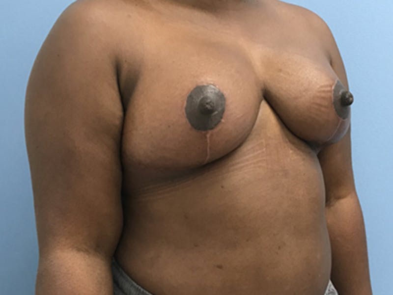 Breast Lift Gallery - Patient 120902813 - Image 4
