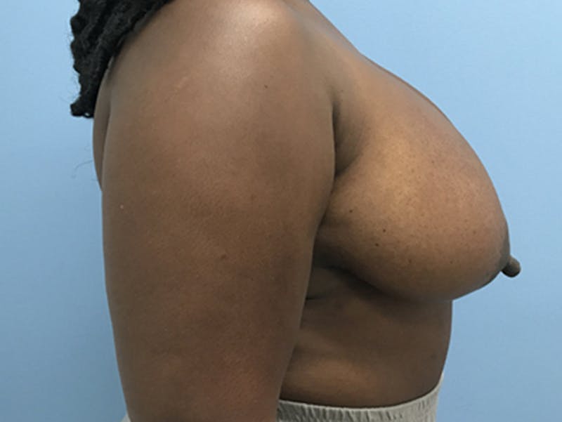 Breast Lift Before & After Gallery - Patient 120902813 - Image 5