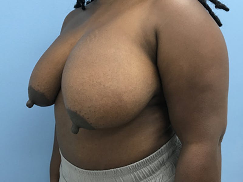 Breast Lift Gallery - Patient 120902813 - Image 7