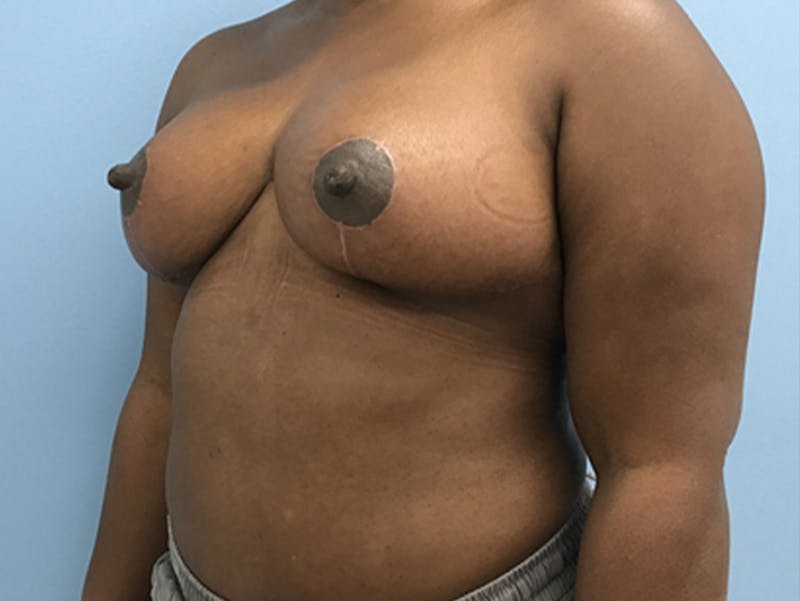 Breast Lift Before & After Gallery - Patient 120902813 - Image 8