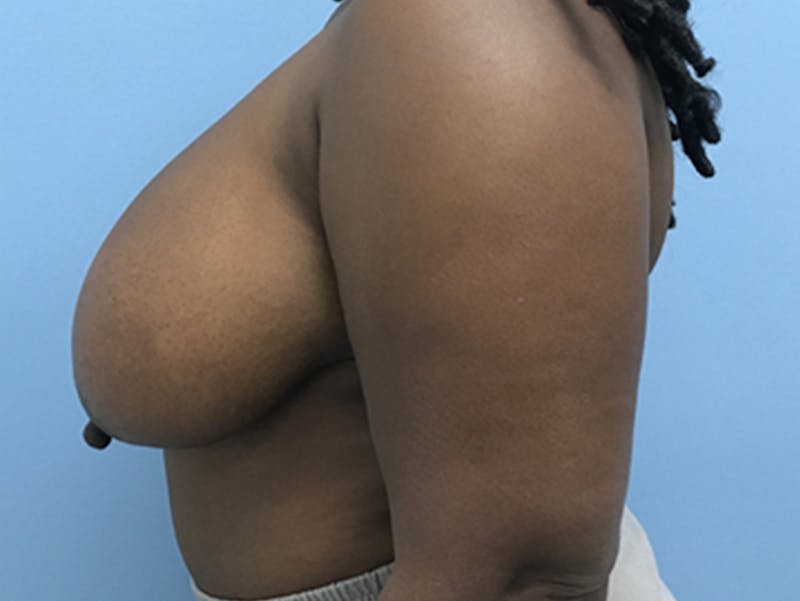 Breast Lift Before & After Gallery - Patient 120902813 - Image 9
