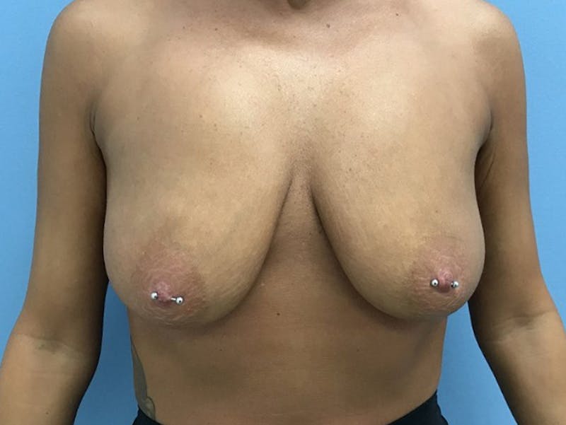 Breast Lift Gallery - Patient 120902815 - Image 1