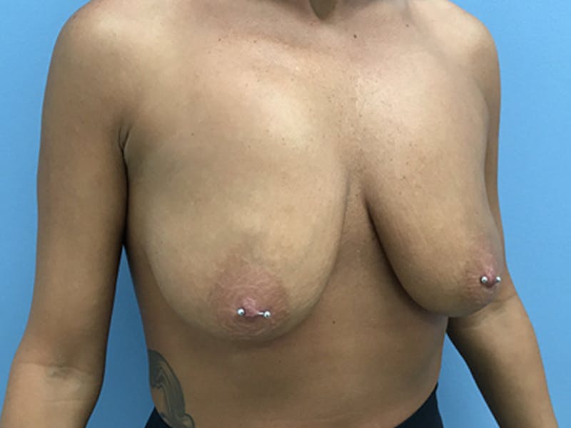 Breast Lift Gallery - Patient 120902815 - Image 3