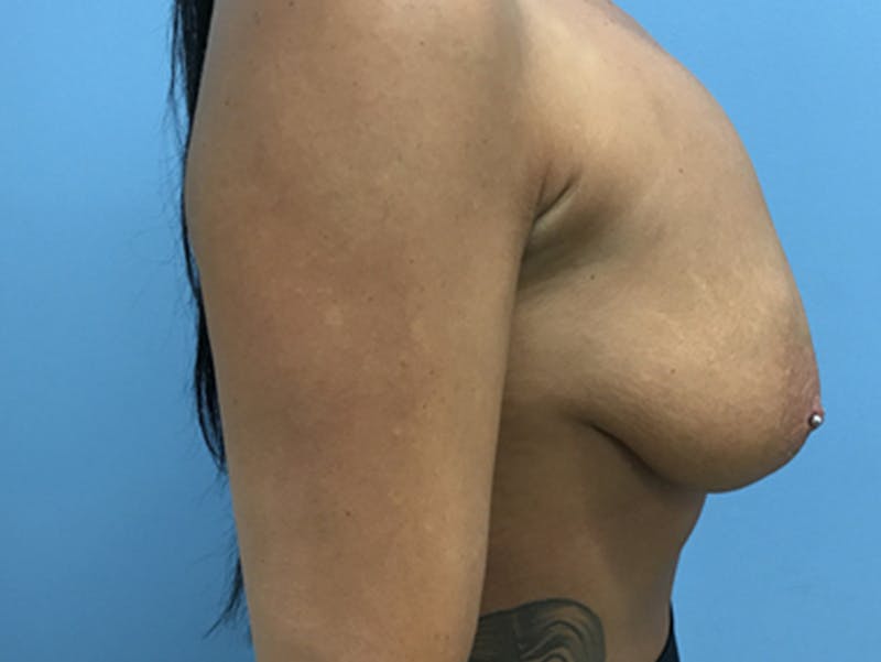 Breast Lift Before & After Gallery - Patient 120902815 - Image 5
