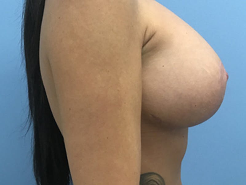 Breast Lift Before & After Gallery - Patient 120902815 - Image 6