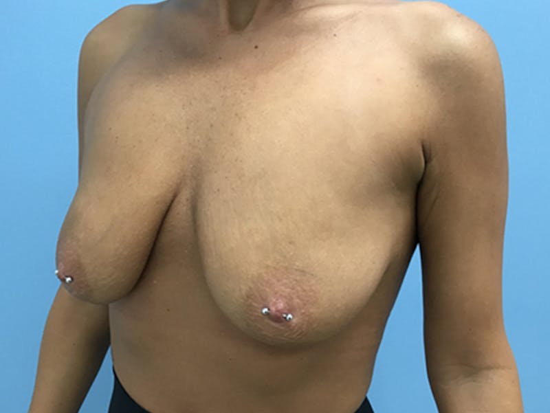 Breast Lift Before & After Gallery - Patient 120902815 - Image 7