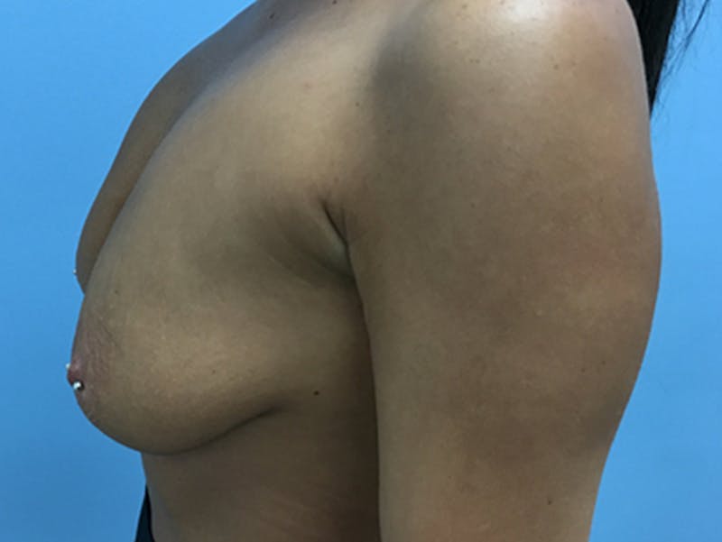 Breast Lift Before & After Gallery - Patient 120902815 - Image 9