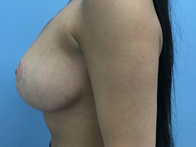 Breast Lift Before & After Gallery - Patient 120902815 - Image 10