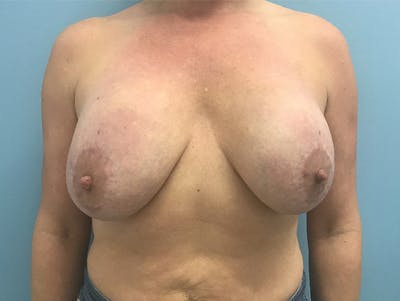 Breast Lift Before & After Gallery - Patient 120902818 - Image 1