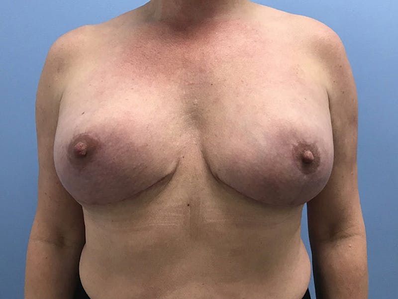 Breast Lift Before & After Gallery - Patient 120902818 - Image 2