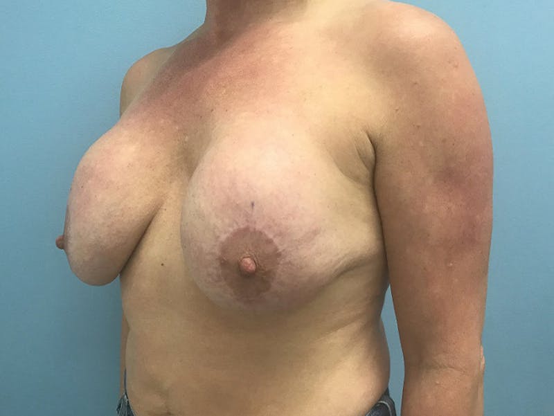Breast Lift Gallery - Patient 120902818 - Image 3