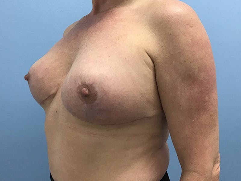 Breast Lift Before & After Gallery - Patient 120902818 - Image 4