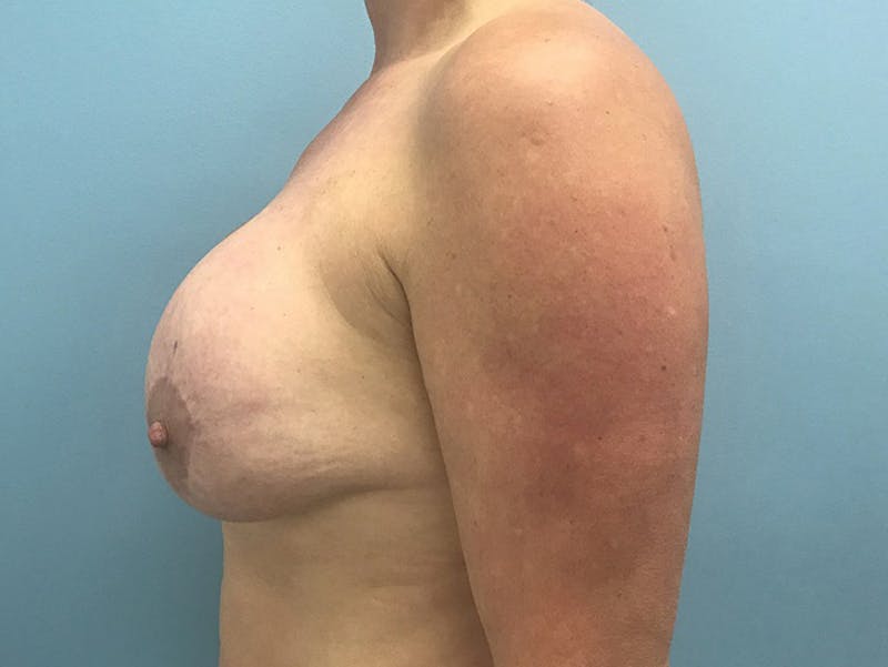 Breast Lift Gallery - Patient 120902818 - Image 5