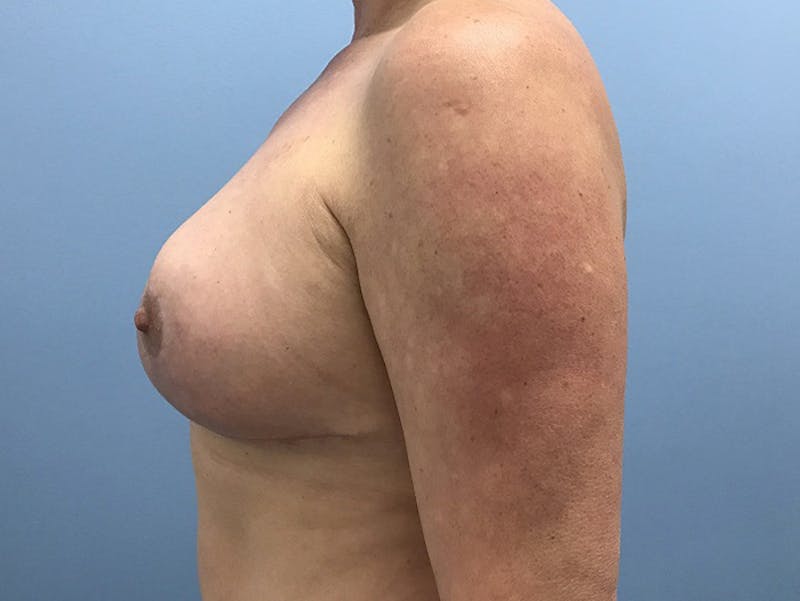 Breast Lift Before & After Gallery - Patient 120902818 - Image 6