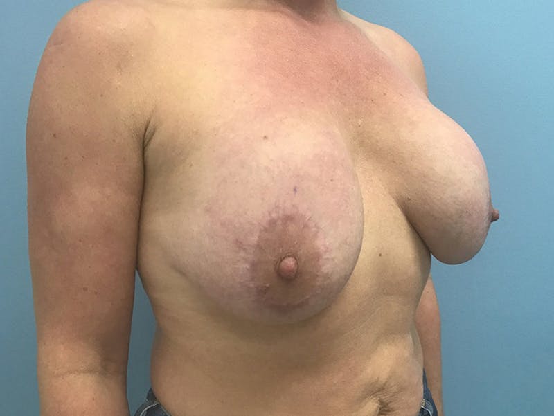 Breast Lift Before & After Gallery - Patient 120902818 - Image 7