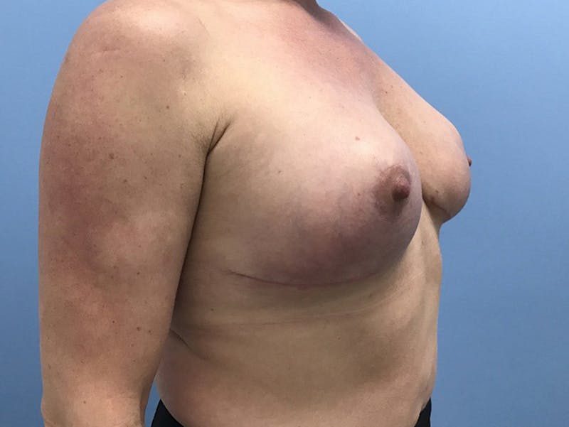Breast Lift Before & After Gallery - Patient 120902818 - Image 8