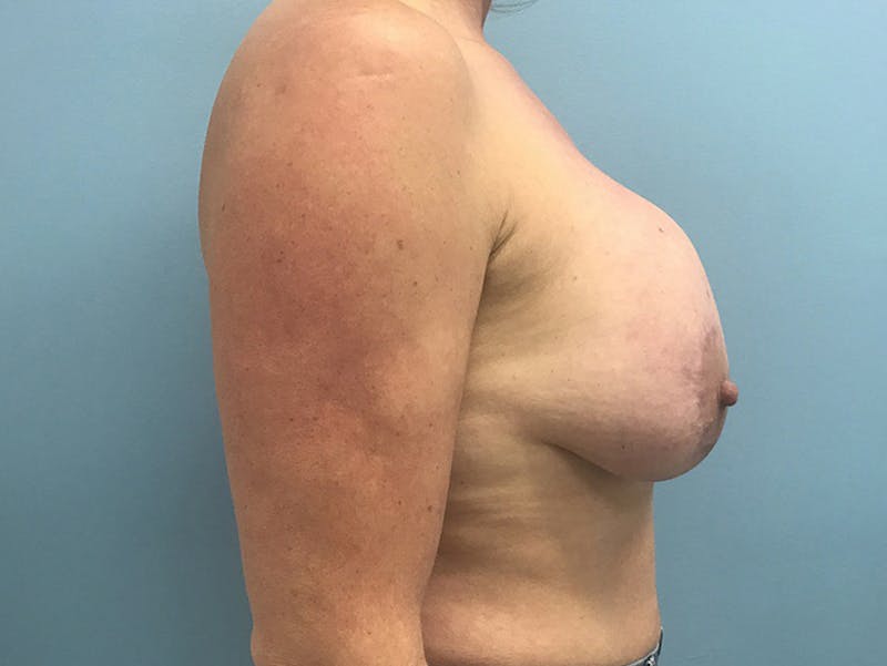 Breast Lift Before & After Gallery - Patient 120902818 - Image 9