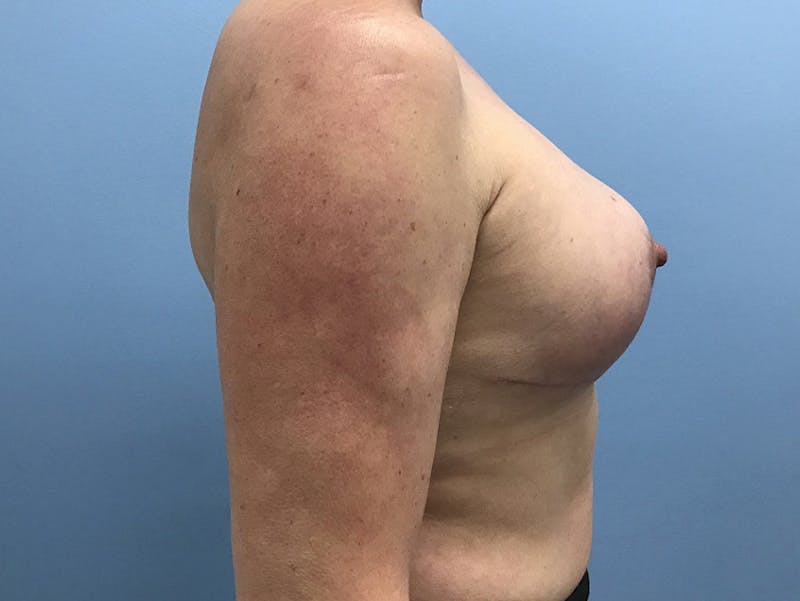 Breast Lift Before & After Gallery - Patient 120902818 - Image 10