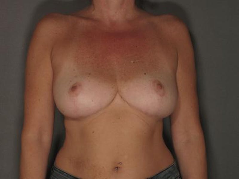 Breast Reduction Before & After Gallery - Patient 120902822 - Image 2