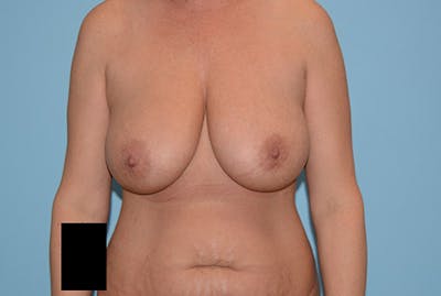 Breast Reduction Before & After Gallery - Patient 120902824 - Image 1