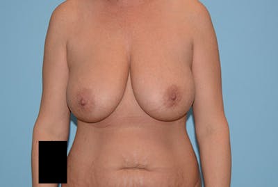 Breast Reduction Before & After Gallery - Patient 120902824 - Image 1