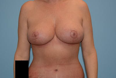 Breast Reduction Before & After Gallery - Patient 120902824 - Image 2
