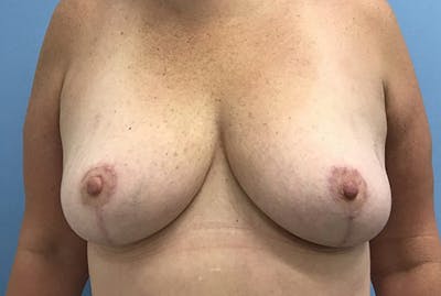 缩小乳房前后图片库-患者120902825 -图2